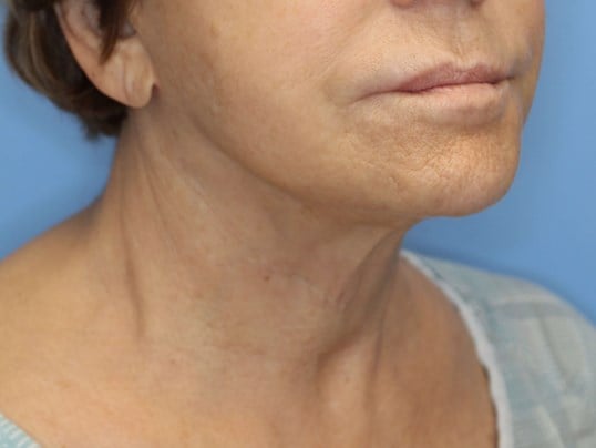 Secondary Neck Lift Before