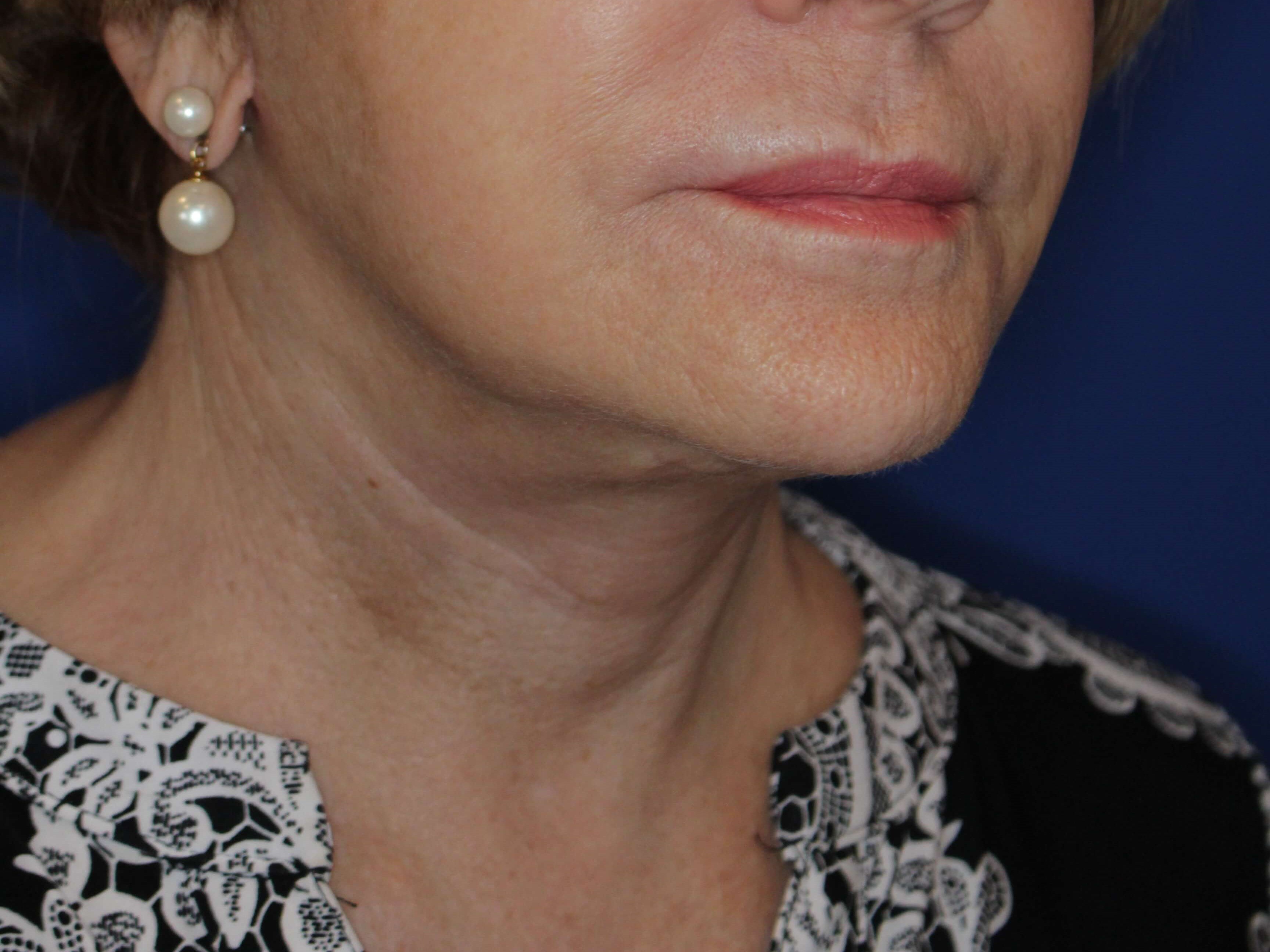 Secondary Neck Lift After