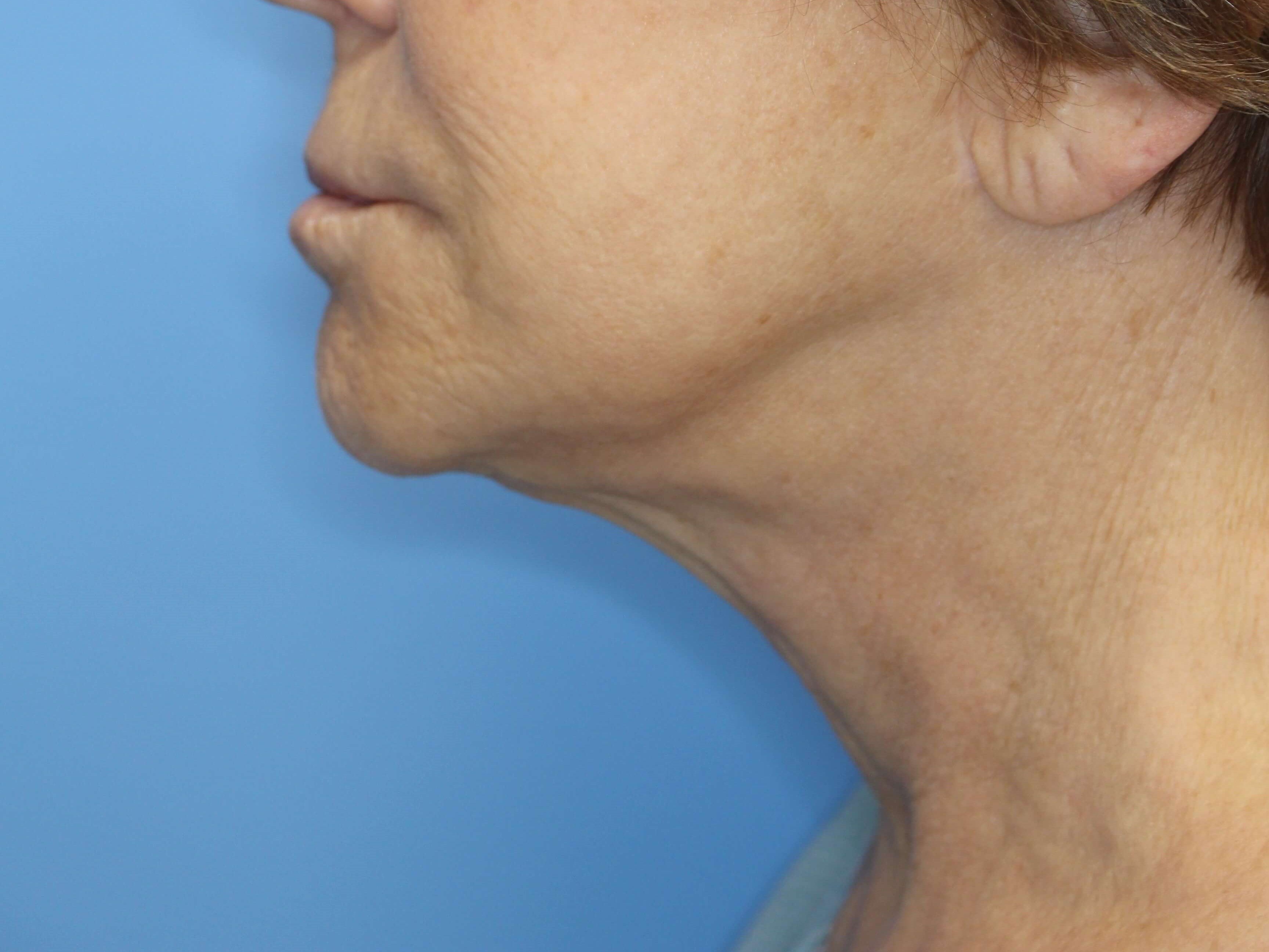 Secondary Neck Lift Before