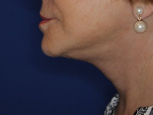 Secondary Neck Lift After