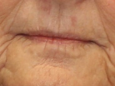 Fat Injection to Lip Before