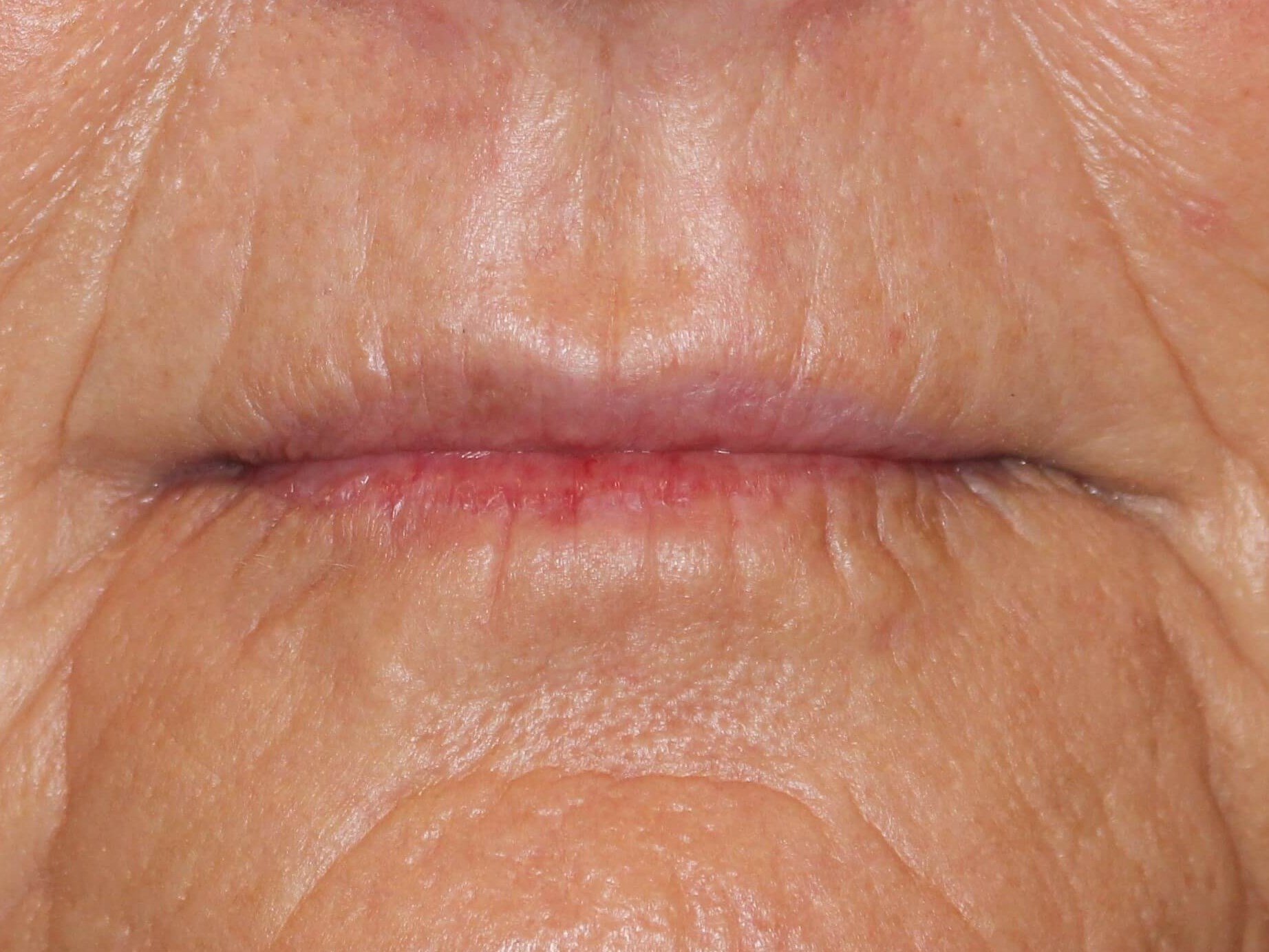 Fat Injection to Lip After