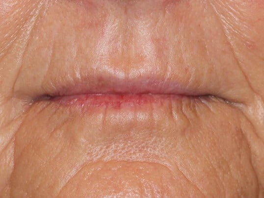 Fat Injection to Lip After
