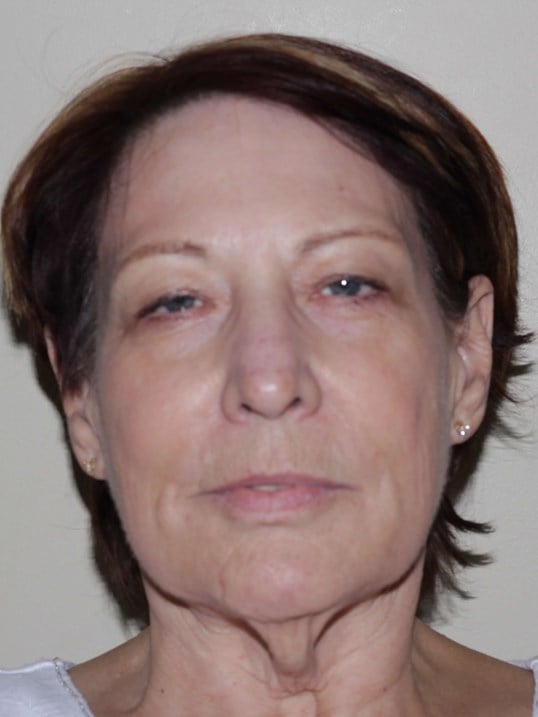 Face Lift Before