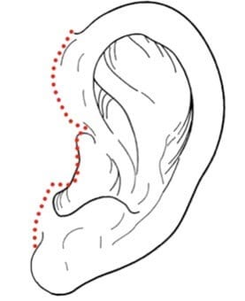 Face Lift Scar Diagram of the scar