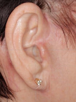 Face Lift Scar Actual Scar