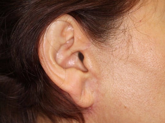 Face Lift Scar After