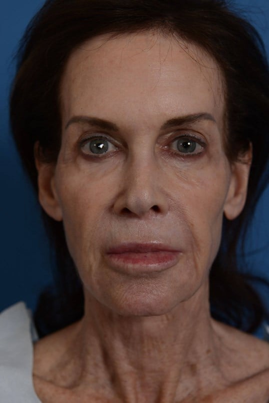 Face Lift & Fat Injection Before