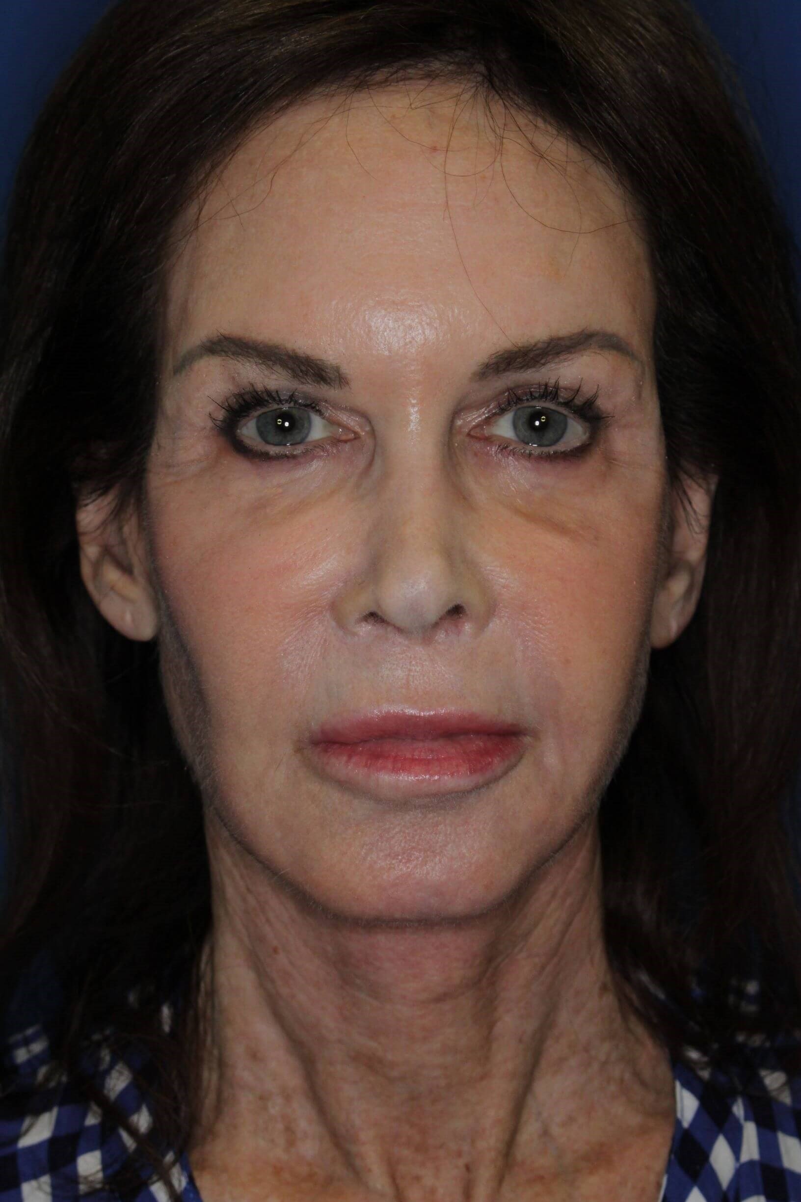 Face Lift & Fat Injection After
