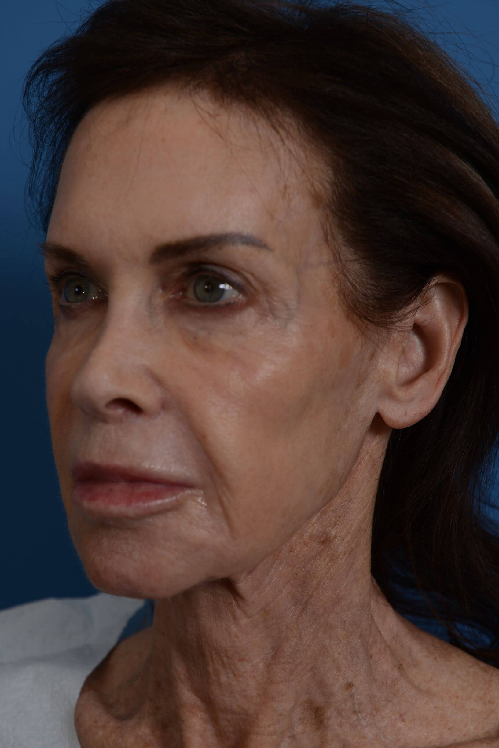 Face Lift & Fat Injection Before