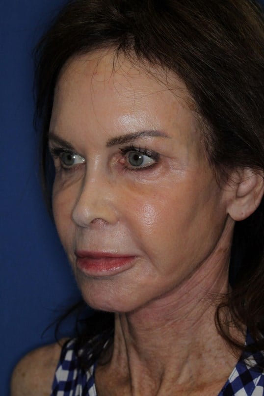 Face Lift & Fat Injection After