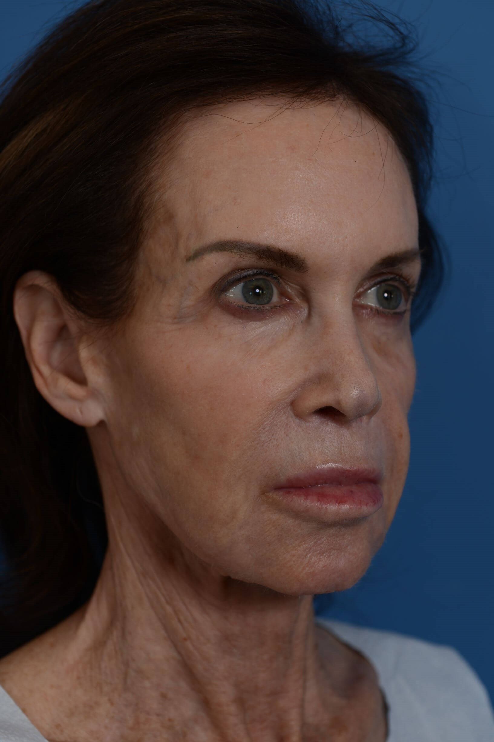 Face Lift & Fat Injection Before