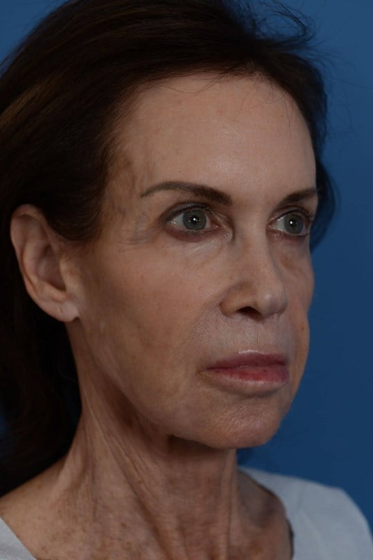 Face Lift & Fat Injection Before