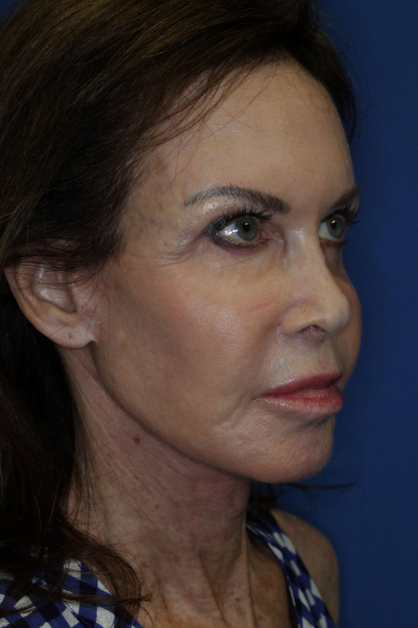 Face Lift & Fat Injection After