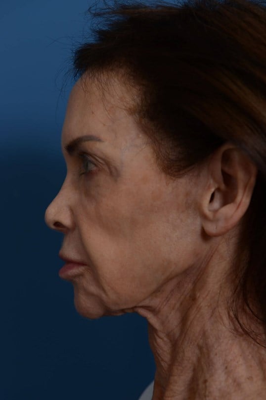 Face Lift & Fat Injection Before