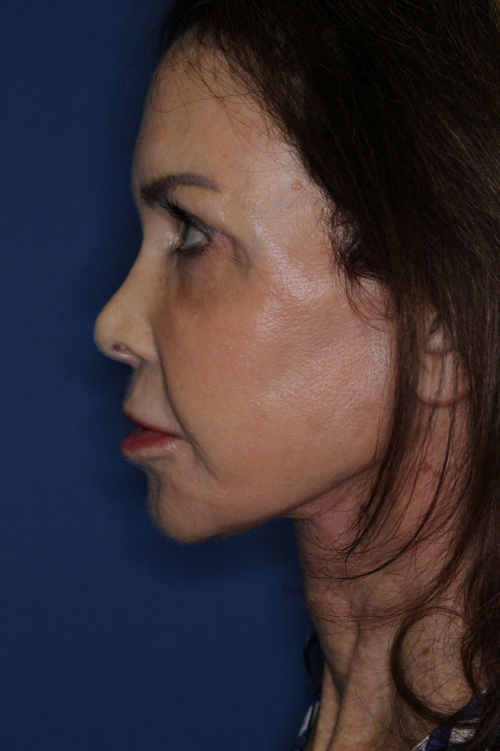 Face Lift & Fat Injection After