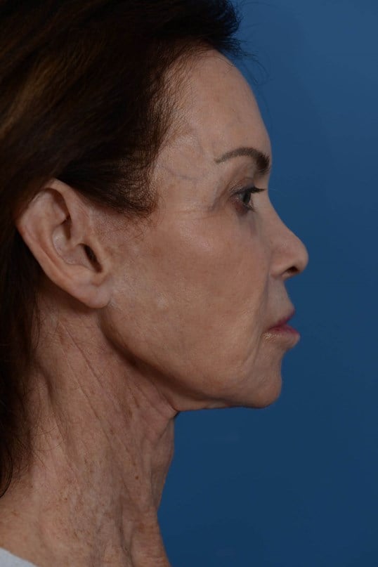 Face Lift & Fat Injection Before