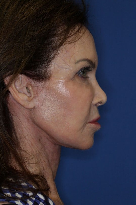 Face Lift & Fat Injection After