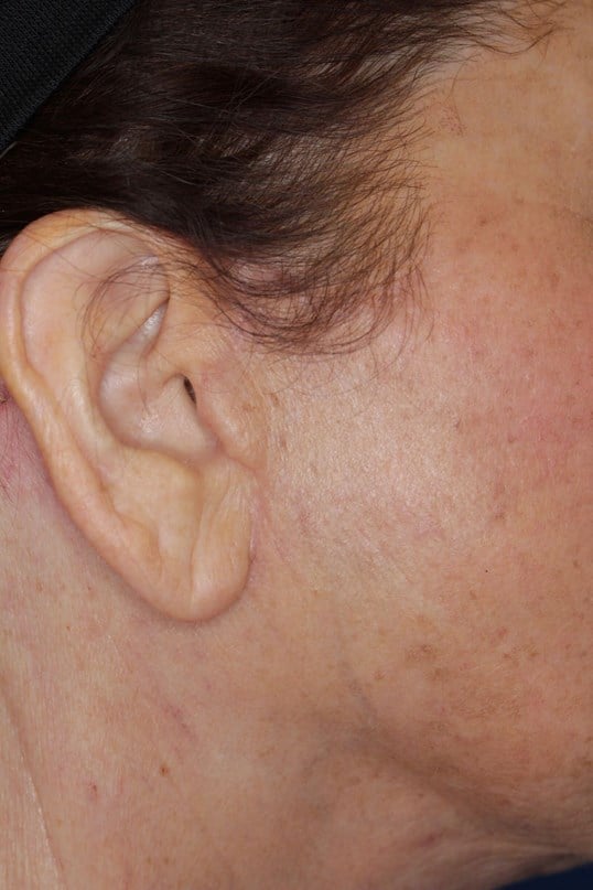 Face Lift Actual Scar