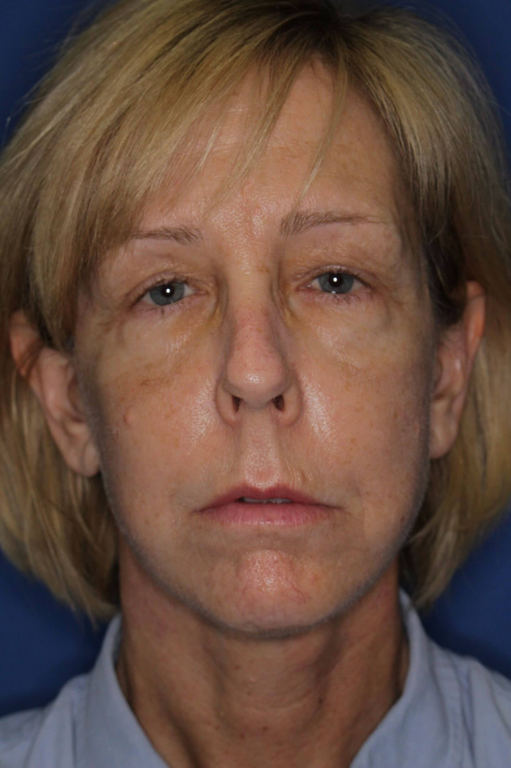 Face Lift & Fat Injection After