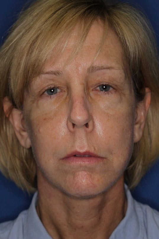 Face Lift & Fat Injection After