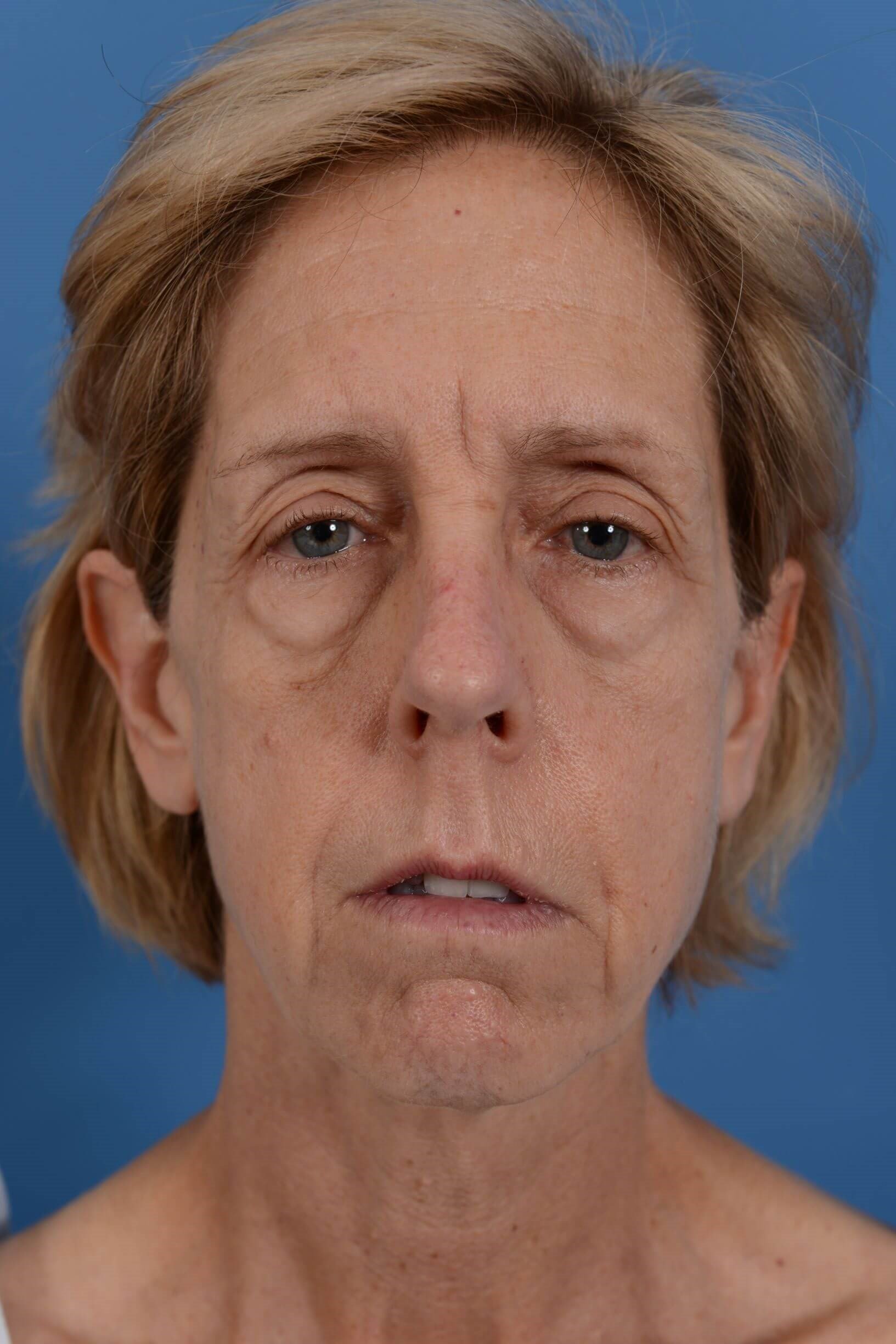 Face Lift & Fat Injection Before