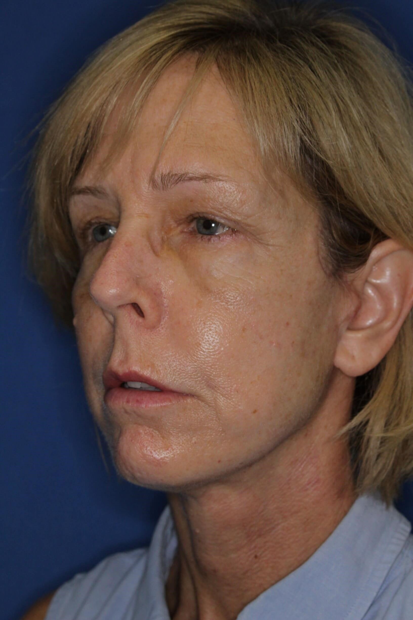 Face Lift & Fat Injection After