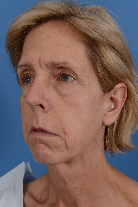 Face Lift & Fat Injection Before