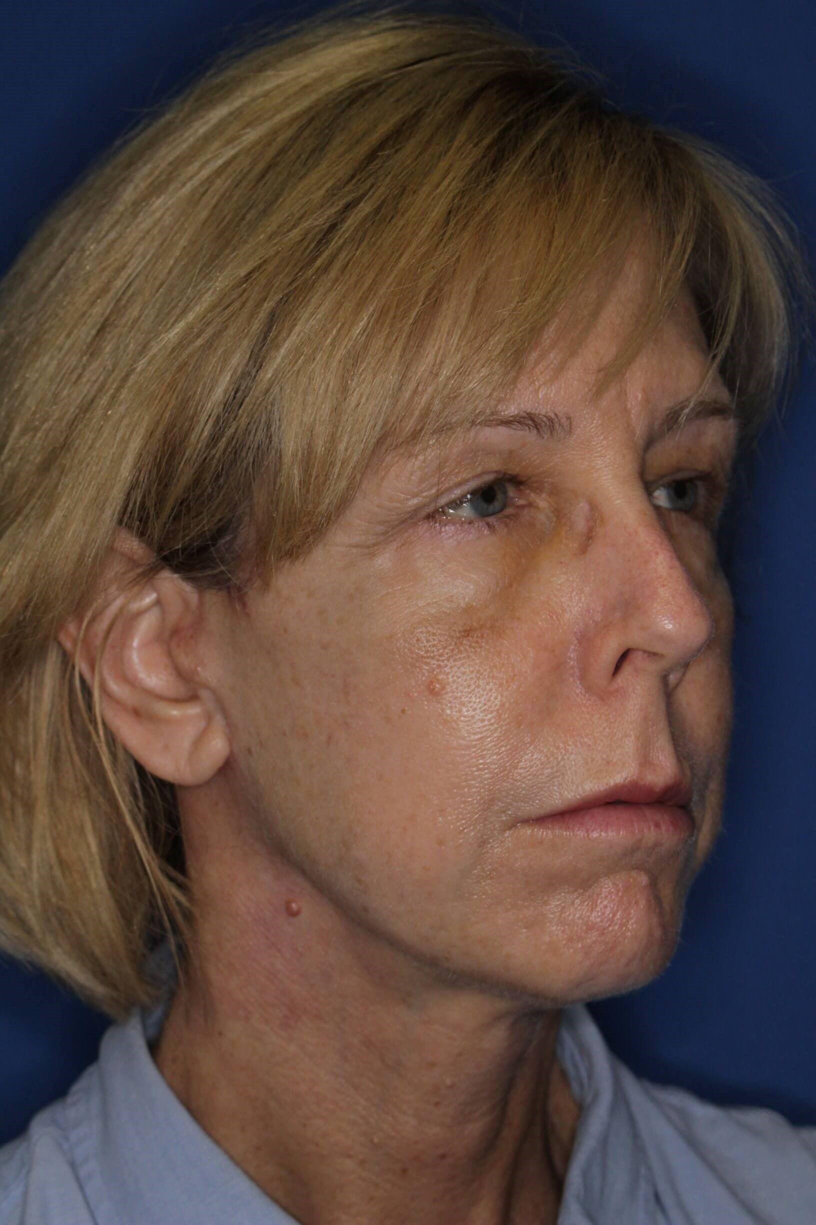 Face Lift & Fat Injection After