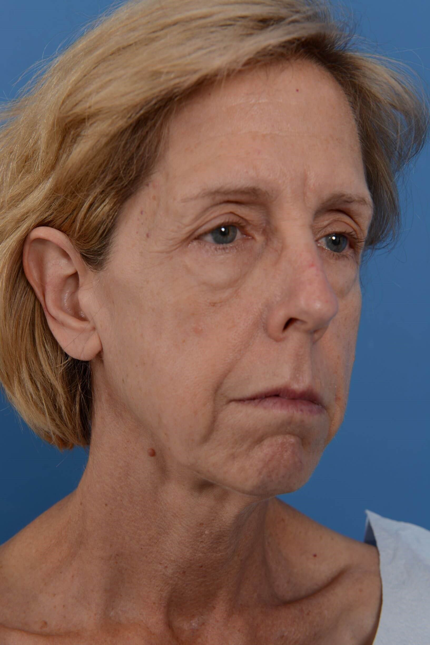 Face Lift & Fat Injection Before