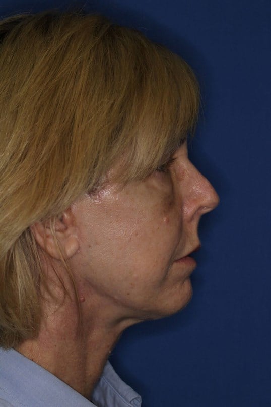 Face Lift & Fat Injection After