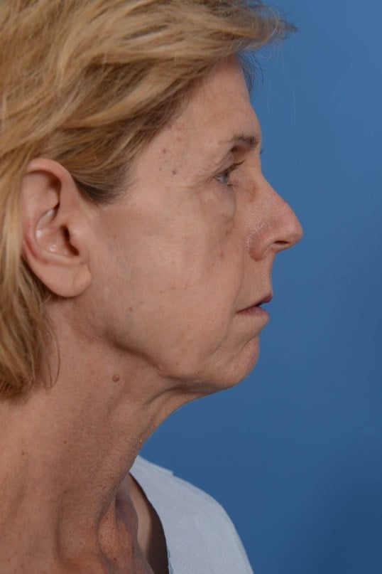 Face Lift & Fat Injection Before