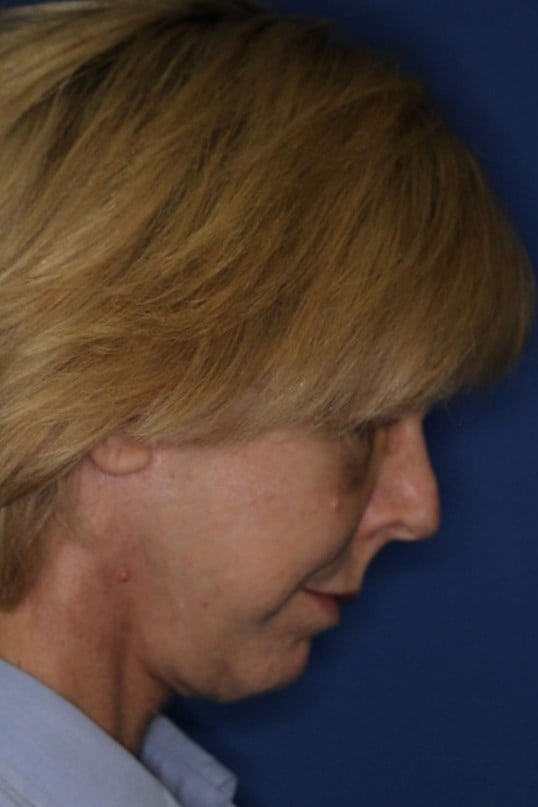 Face Lift & Fat Injection After