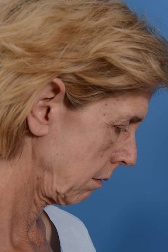 Face Lift & Fat Injection Before