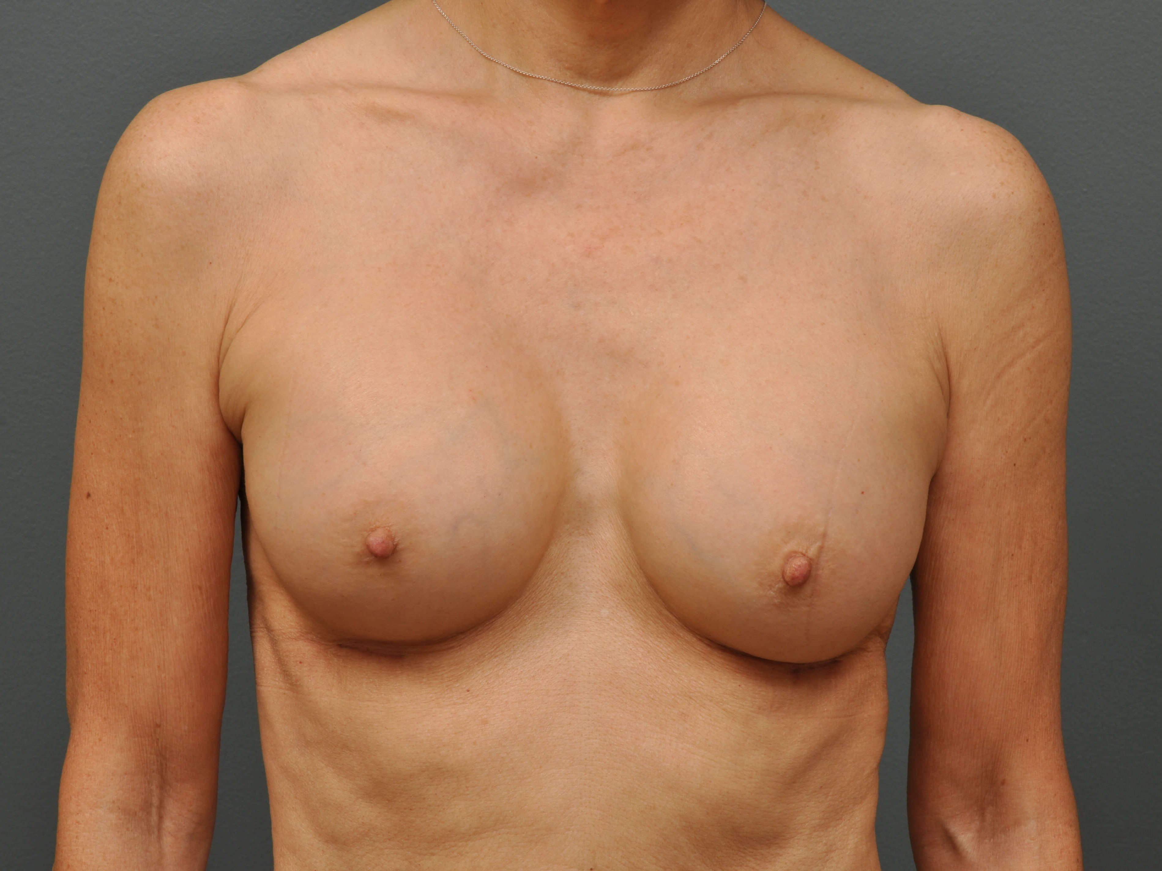 250 cc Silicone Implants After