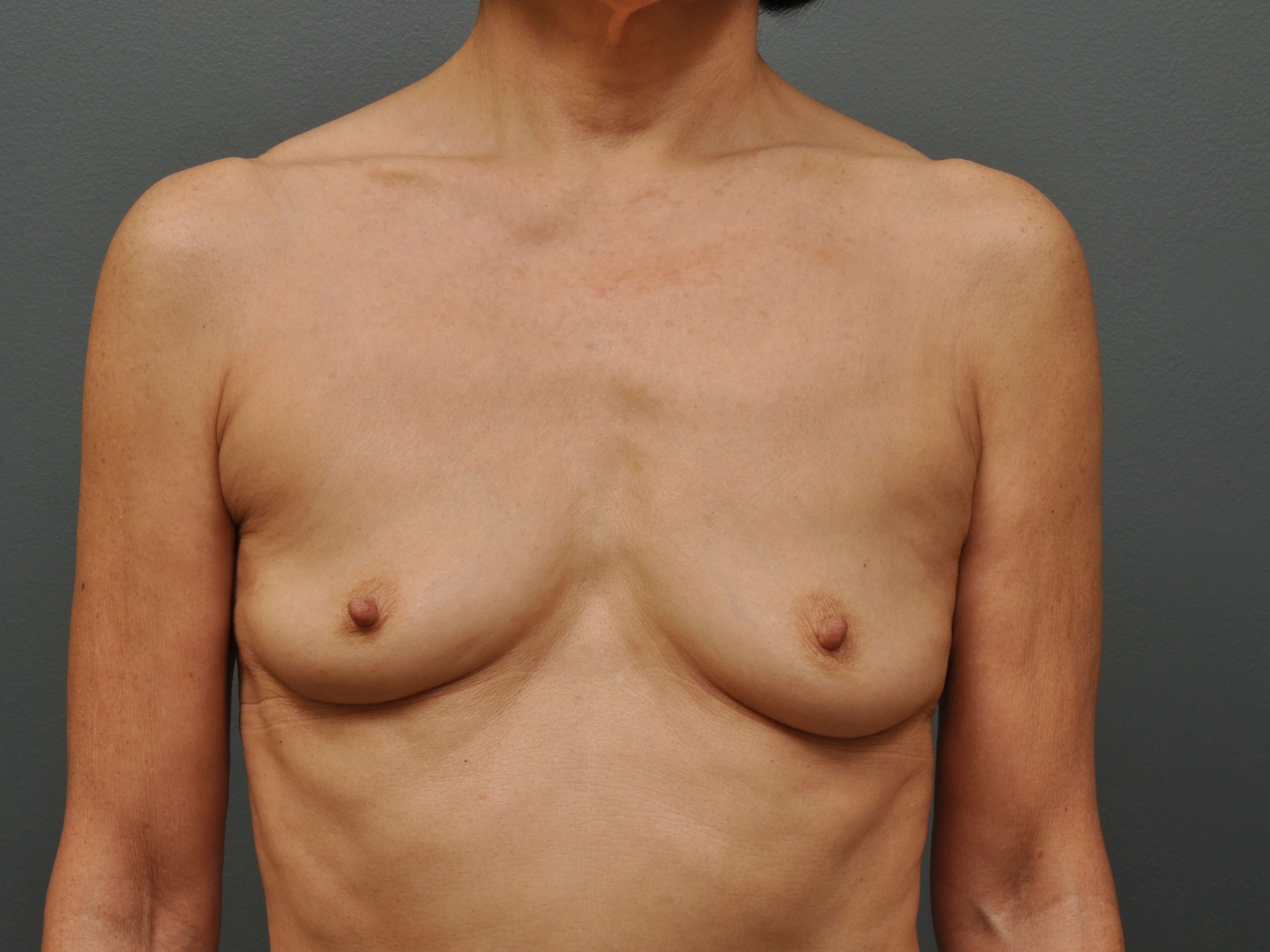 250 cc Silicone Implants Before