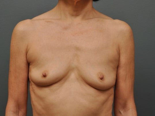 250 cc Silicone Implants Before