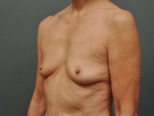 250 cc Silicone Implants Before