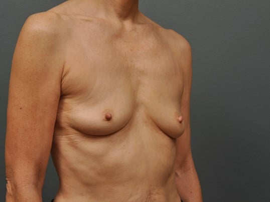 250 cc Silicone Implants Before