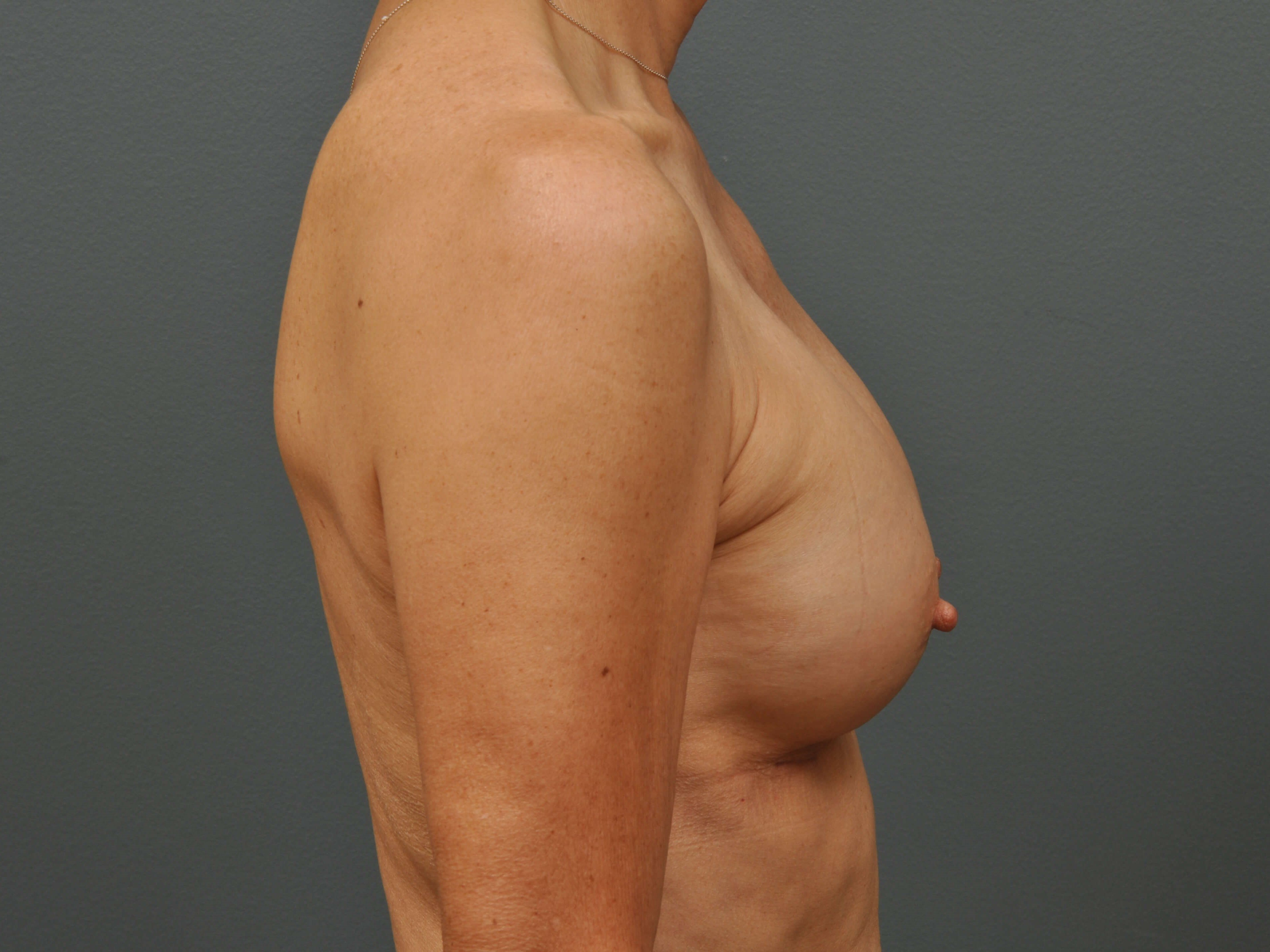 250 cc Silicone Implants After