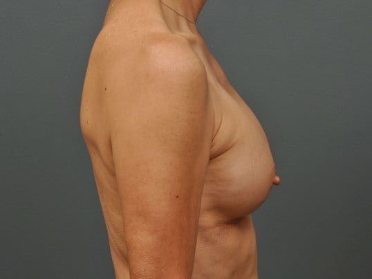 250 cc Silicone Implants After