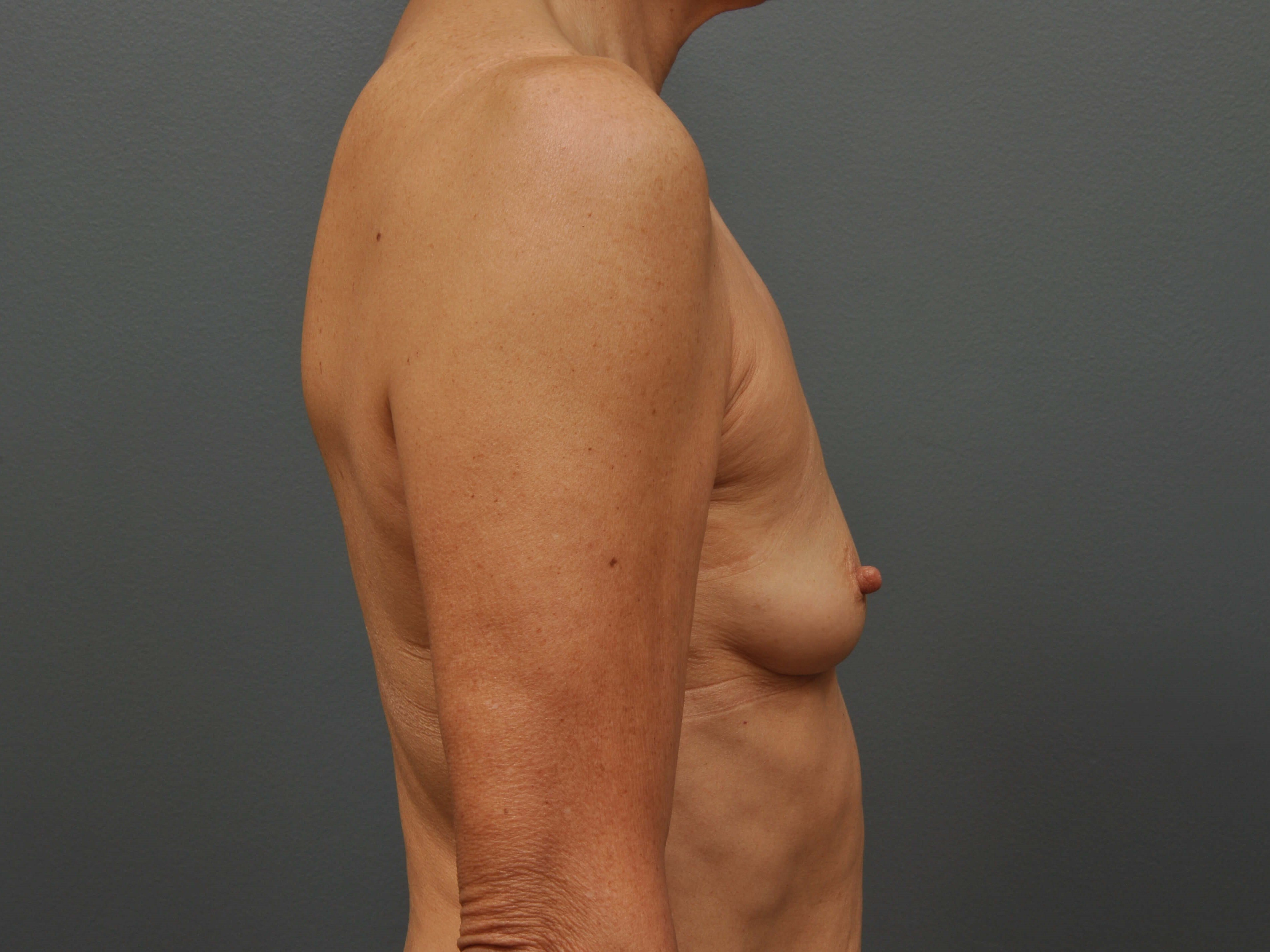 250 cc Silicone Implants Before