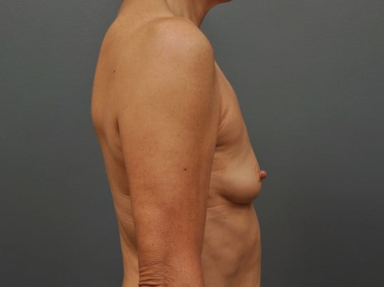 250 cc Silicone Implants Before