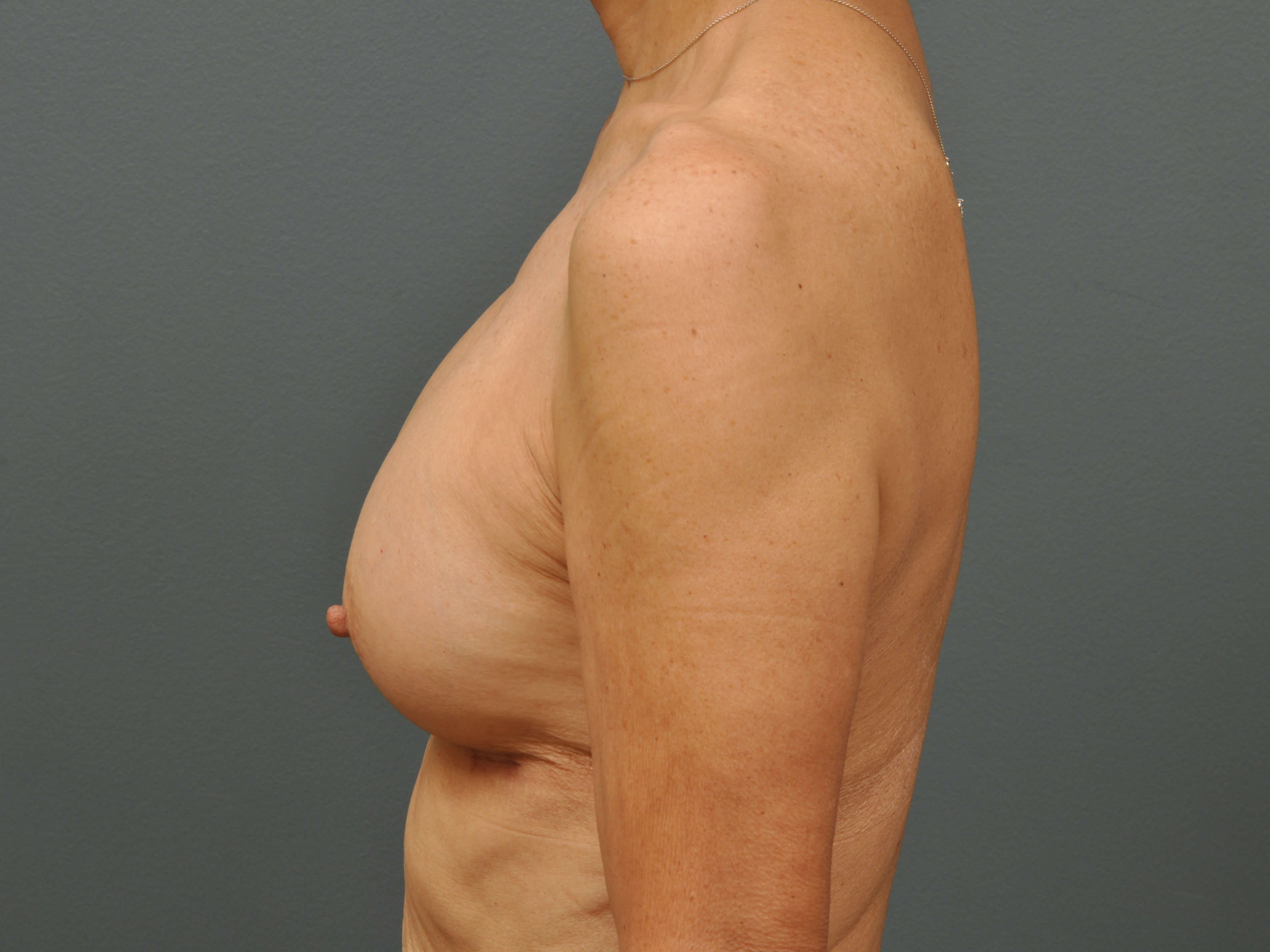 250 cc Silicone Implants After