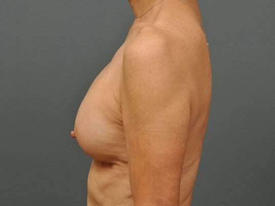 250 cc Silicone Implants After