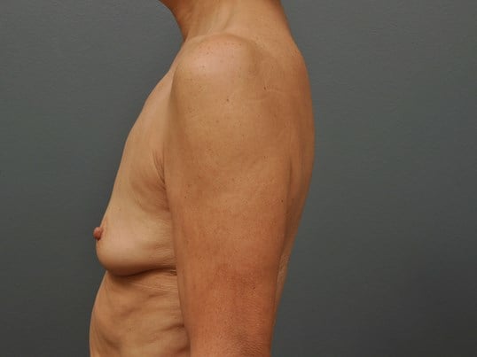 250 cc Silicone Implants Before