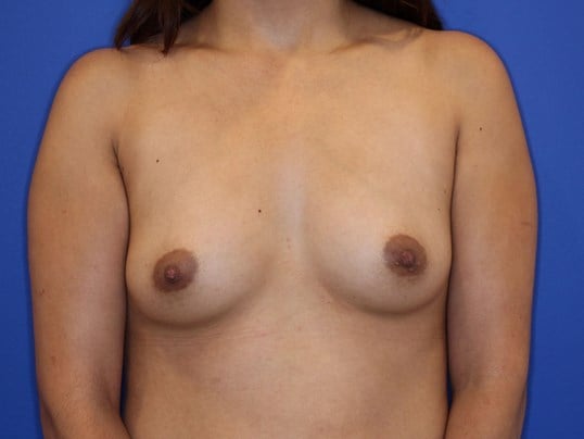 295 cc Silicone Implants Before