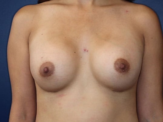 295 cc Silicone Implants After