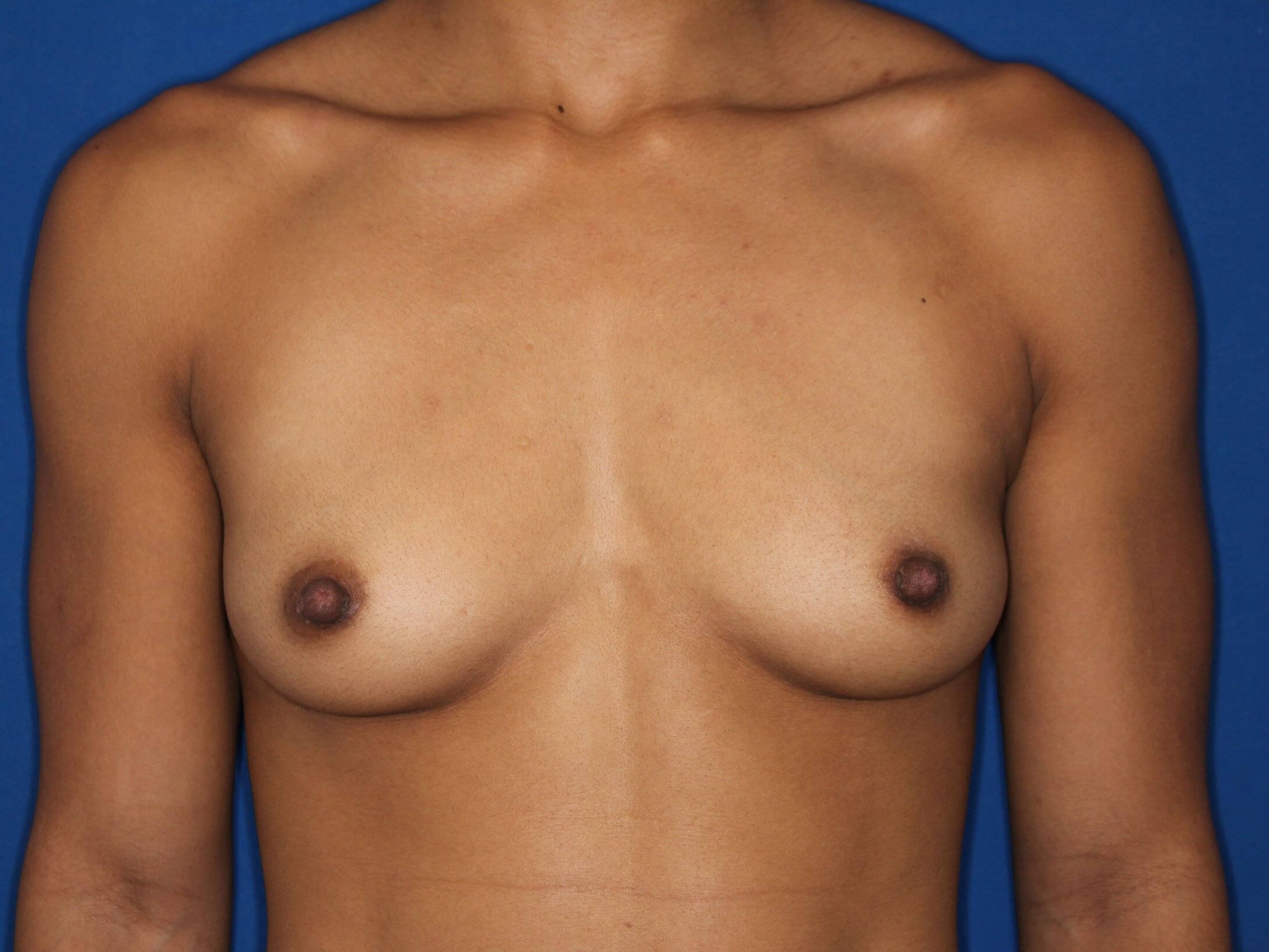 295 cc Silicone Implants Before