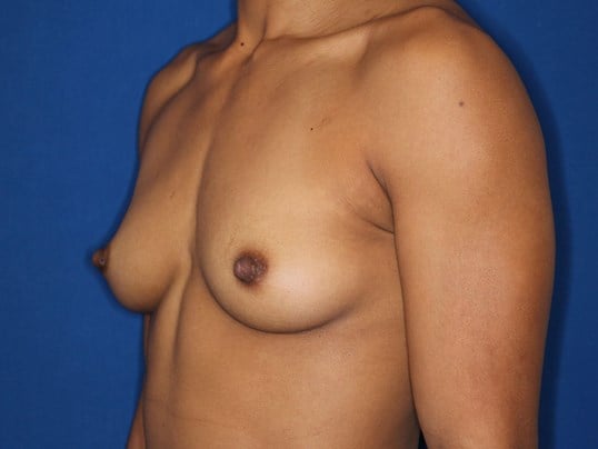 295 cc Silicone Implants Before